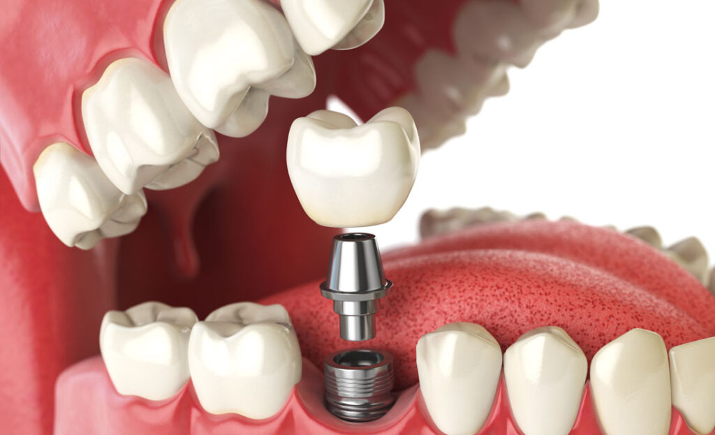 Implantes dentários – O que são e etapas do tratamento