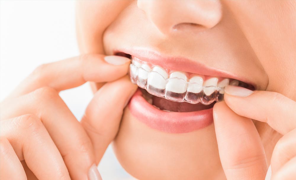 5 vantagens do aparelho dentário invisível