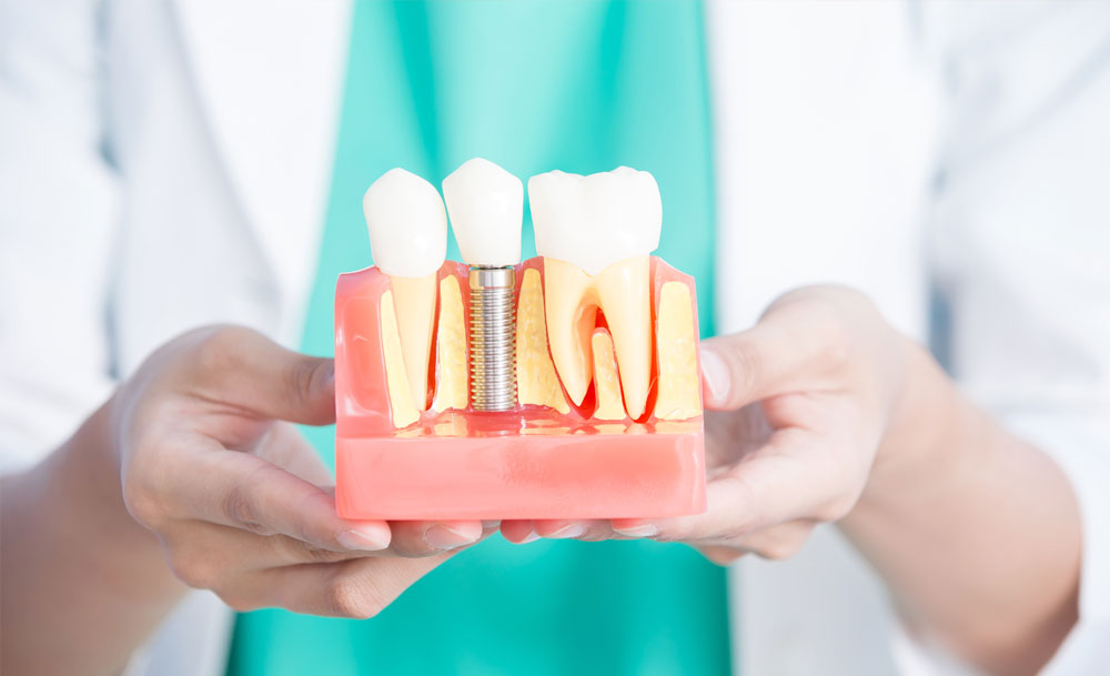 Perda de implante dentário: causas e sintomas