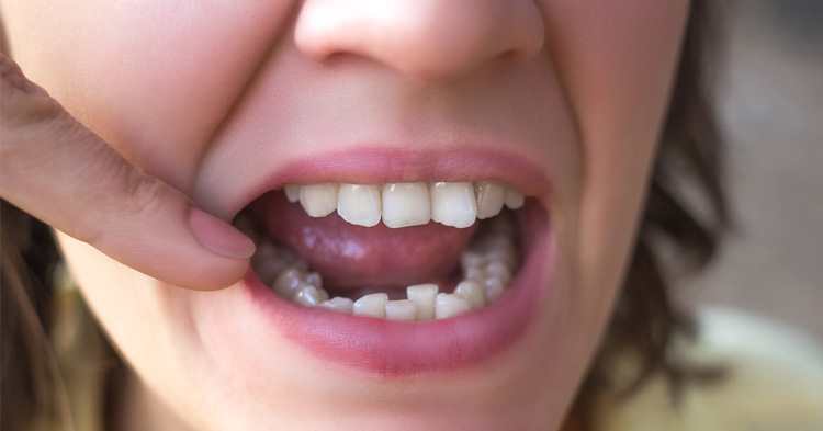 Apinhamento dentário: causas e tratamento
