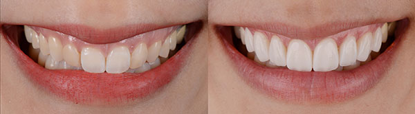 Facetas dentárias na Smile.up - Antes e depois
