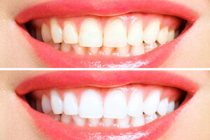 Branqueamento dentário - antes e depois