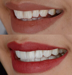 Facetas dentárias - Antes e depois