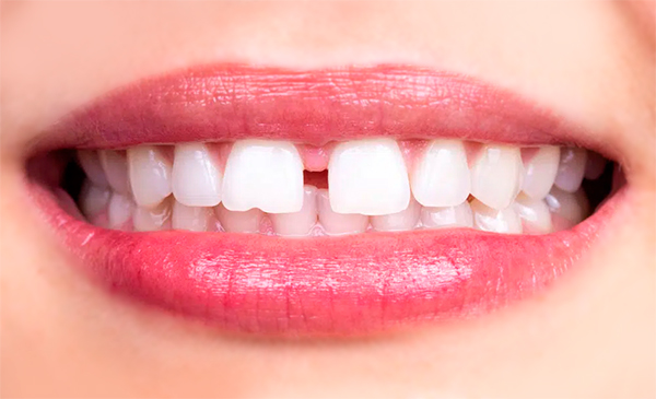 Diastema: como tratar o espaço entre os dentes?